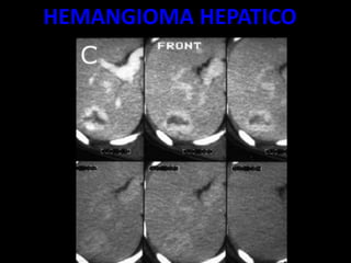 HEMANGIOMA HEPATICO
 