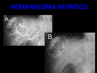 HEMANGIOMA HEPATICO
 