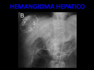 HEMANGIOMA HEPATICO
 