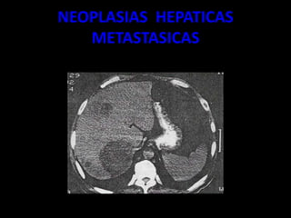 NEOPLASIAS HEPATICAS
METASTASICAS
 