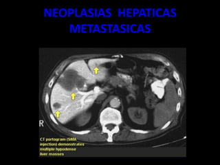 NEOPLASIAS HEPATICAS
METASTASICAS
 