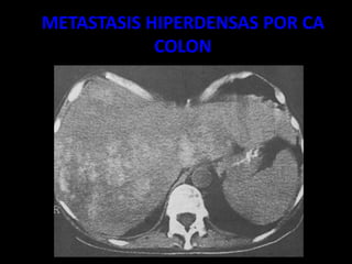METASTASIS HIPERDENSAS POR CA
COLON
 