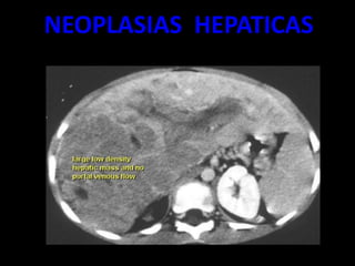 NEOPLASIAS HEPATICAS
 