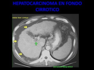 HEPATOCARCINOMA EN FONDO
CIRROTICO
 