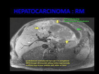 HEPATOCARCINOMA : RM
 