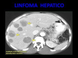LINFOMA HEPATICO
 