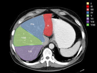 VII
VIII
IVa
II
I
II
III
IV
V
VI
VII
VIII
 