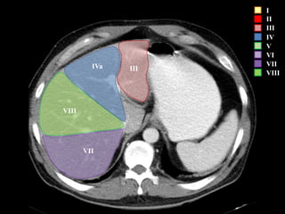 I
II
III
IV
V
VI
VII
VIII
VII
VIII
IVa III
 