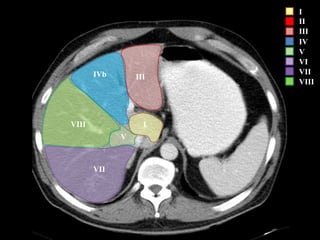 I
II
III
IV
V
VI
VII
VIII
VII
V
IVIII
IVb III
 