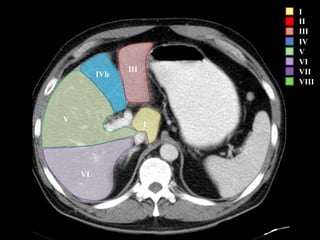 I
II
III
IV
V
VI
VII
VIII
VI
V
I
IVb
III
 