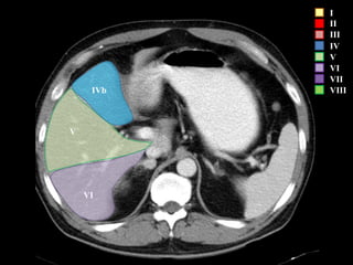 I
II
III
IV
V
VI
VII
VIII
VI
V
IVb
 