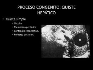PROCESO CONGENITO: QUISTE
HEPÁTICO
• Quiste simple
• Circular
• Membrana periférica
• Contenido econegativo.
• Refuerzo posterior.
 
