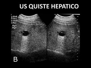 US QUISTE HEPATICO
 