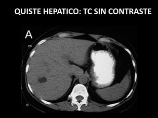 QUISTE HEPATICO: TC SIN CONTRASTE
 
