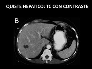 QUISTE HEPATICO: TC CON CONTRASTE
 