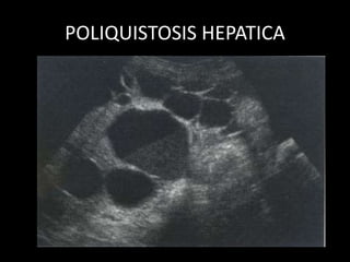 POLIQUISTOSIS HEPATICA
 