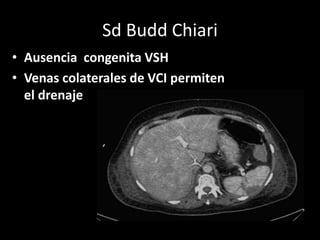 Sd Budd Chiari
• Ausencia congenita VSH
• Venas colaterales de VCI permiten
el drenaje
 