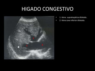 HIGADO CONGESTIVO
• 1.-Vena suprahepática dilatada.
• 2.-Vena cava inferior dilatada.
1
1 2
 