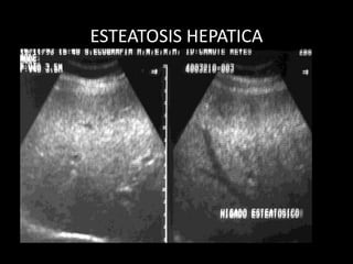 ESTEATOSIS HEPATICA
 