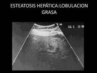 ESTEATOSIS HEPÁTICA:LOBULACION
GRASA
 