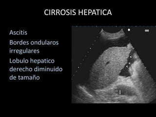 CIRROSIS HEPATICA
Ascitis
Bordes ondularos
irregulares
Lobulo hepatico
derecho diminuido
de tamaño
 