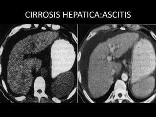 CIRROSIS HEPATICA:ASCITIS
 