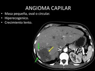 ANGIOMA CAPILAR
• Masa pequeña, oval o circular.
• Hiperecogenico.
• Crecimiento lento.
 