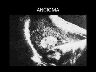 ANGIOMA
 