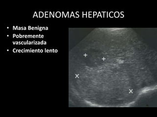 ADENOMAS HEPATICOS
• Masa Benigna
• Pobremente
vascularizada
• Crecimiento lento
 