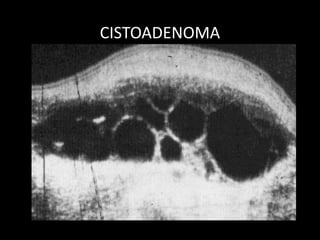 CISTOADENOMA
 
