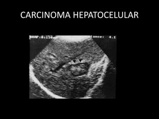 CARCINOMA HEPATOCELULAR
 