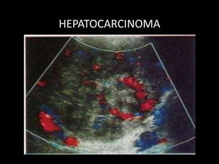 HEPATOCARCINOMA
 