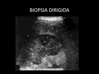 BIOPSIA DIRIGIDA
 