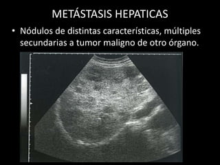 METÁSTASIS HEPATICAS
• Nódulos de distintas características, múltiples
secundarias a tumor maligno de otro órgano.
 