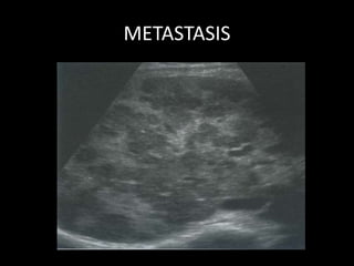 METASTASIS
 