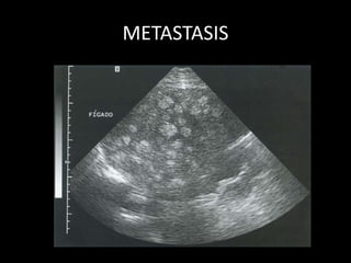 METASTASIS
 