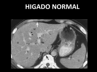 HIGADO NORMAL
 