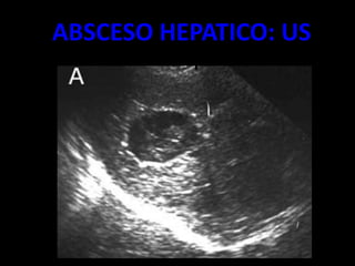 ABSCESO HEPATICO: US
 