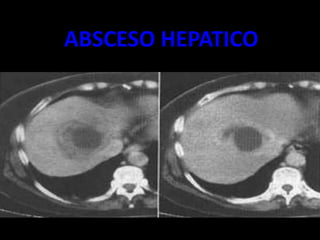 ABSCESO HEPATICO
6
 