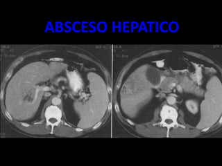 ABSCESO HEPATICO
 
