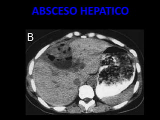 ABSCESO HEPATICO
 