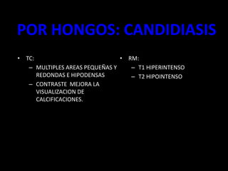 POR HONGOS: CANDIDIASIS
• TC:
– MULTIPLES AREAS PEQUEÑAS Y
REDONDAS E HIPODENSAS
– CONTRASTE MEJORA LA
VISUALIZACION DE
CALCIFICACIONES.
• RM:
– T1 HIPERINTENSO
– T2 HIPOINTENSO
 