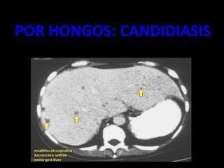 POR HONGOS: CANDIDIASIS
 