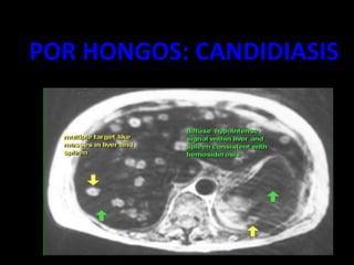 POR HONGOS: CANDIDIASIS
 