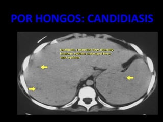 POR HONGOS: CANDIDIASIS
 