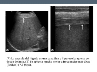 (A) La capsula del hígado es una capa fina e hiperecoica que se ve
desde delante. (B) Se aprecia mucho mejor a frecuencias mas altas
(flechas) (7,5 MHz).
 