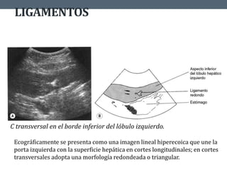 LIGAMENTOS
Ecográficamente se presenta como una imagen lineal hiperecoica que une la
porta izquierda con la superficie hepática en cortes longitudinales; en cortes
transversales adopta una morfología redondeada o triangular.
C transversal en el borde inferior del lóbulo izquierdo.
 