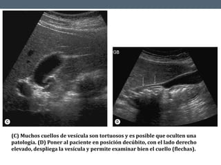 (C) Muchos cuellos de vesícula son tortuosos y es posible que oculten una
patología. (D) Poner al paciente en posición decúbito, con el lado derecho
elevado, despliega la vesícula y permite examinar bien el cuello (flechas).
 