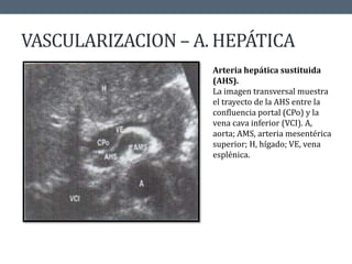 VASCULARIZACION – A. HEPÁTICA
Arteria hepática sustituida
(AHS).
La imagen transversal muestra
el trayecto de la AHS entre la
confluencia portal (CPo) y la
vena cava inferior (VCI). A,
aorta; AMS, arteria mesentérica
superior; H, hígado; VE, vena
esplénica.
 