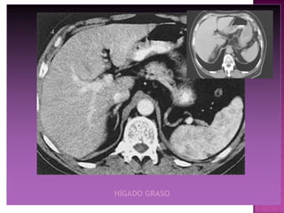 HÍGADO GRASO
 